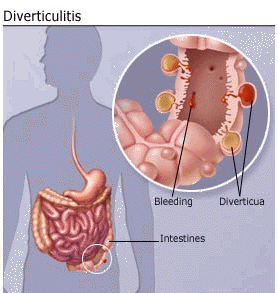 How Serious is DIVERTICULITIS Disease?